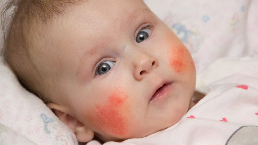 Что означают красные пятна на щеках ребенка весной?