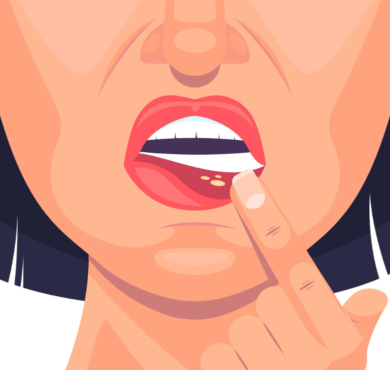 Простой герпес: что это такое, как проявляется и почему случаются рецидивы